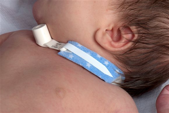 Dale Tracheostomy Tube Holder Kleinkinder 242